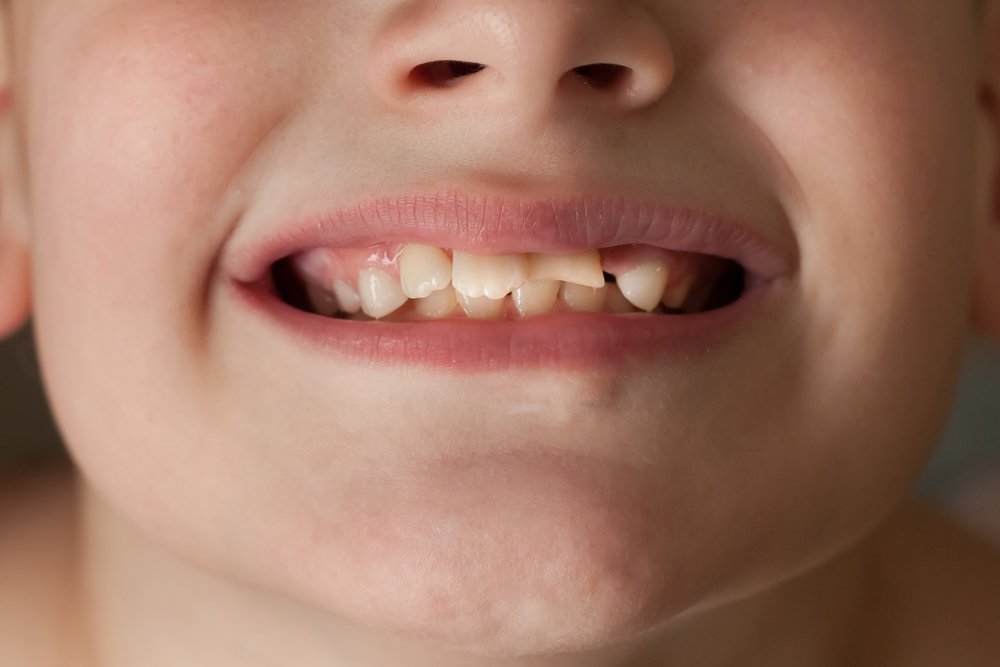 Виды травм зубов и их последствия