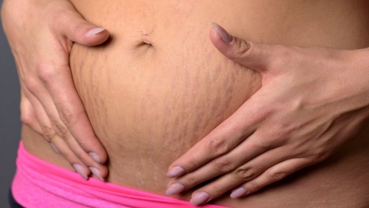 Беременность и другие причины появления растяжек на животе